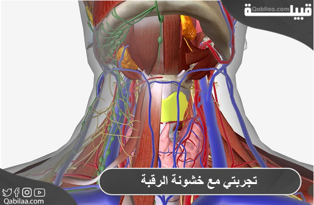 تجربتي مع خشونة الرقبة