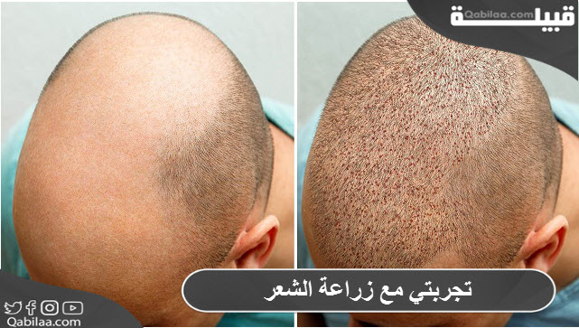 تجربتي مع زراعة الشعر