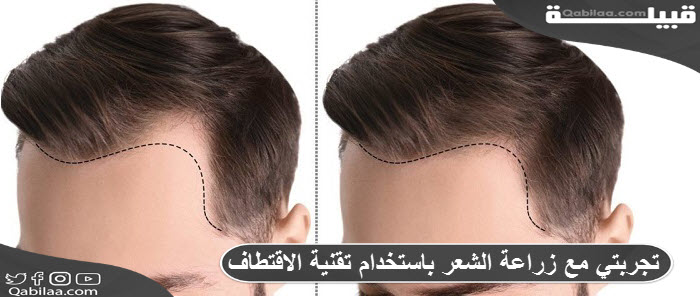 تجربتي مع زراعة الشعر باستخدام تقنية الاقتطاف