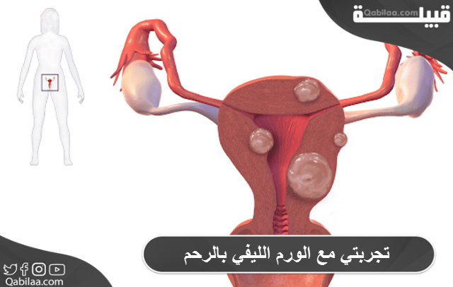 تجربتي مع الورم الليفي بالرحم