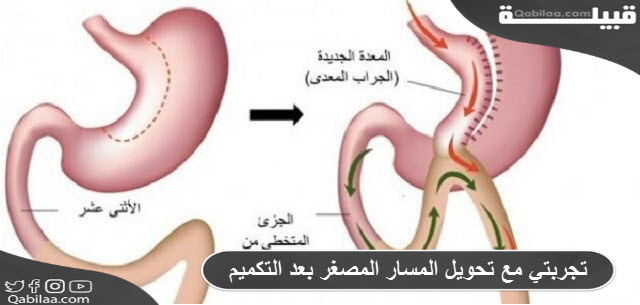 تجربتي مع تحويل المسار المصغر بعد التكميم