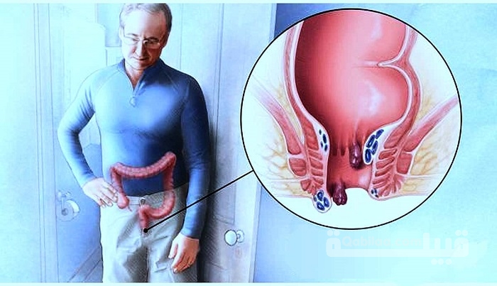سبب حرقان في فتحة الشرج