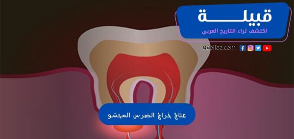 علاج خراج الضرس المحشو