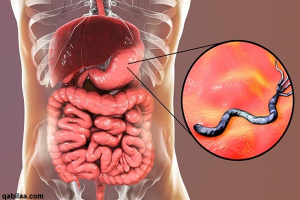 علاج جرثومة المعدة بالأعشاب